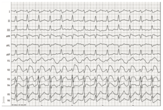 Renz Brugada Phenocopy Figure 1