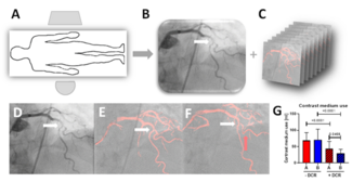 Figure 1. Generation and use of a dynamic coronary roadmap during percutaneous coronary intervention