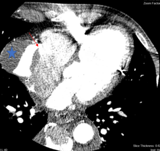 Figure 2. Computed tomography showing fistula 