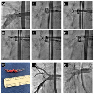 Figure. Angiogram 
