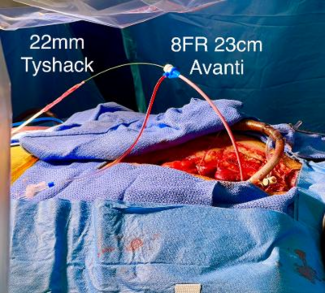 Figure 2. 22 x 5-mm Tyshack II balloon 