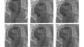 Figure 2. Aortogram