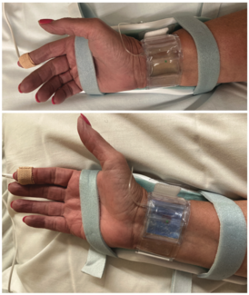 Meitler Transradial Hemostasis Figure 1