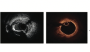Kern Intracoronary Imaging