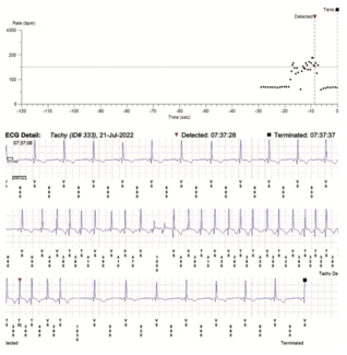 Zeroka Cardiac Implantable Figure 1
