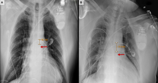 Figure 4. Changes in IABP position 