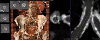 Figure 1. Computed tomography-angiography of the aorta