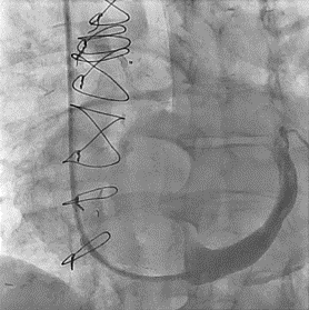 Figure. Coronary sinus reducer procedure. 
