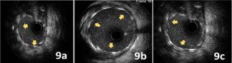 Figure 9. (A) Intravascular ultrasound 