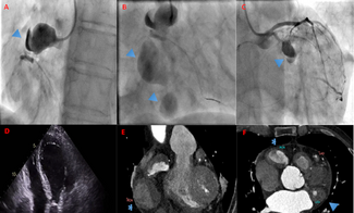 Figure.  (A) Angiogram of the right coronary artery 