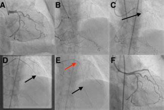 Figure. Coronary angiogram 