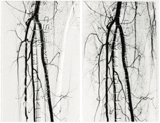 Kapur Peripheral Artery Disease Figure 1