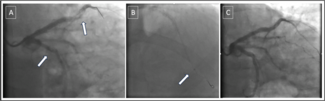 Figure. Left coronary angiography 