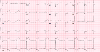 Figure. Electrocardiogram 