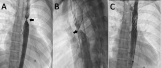 Figure. Aortogram