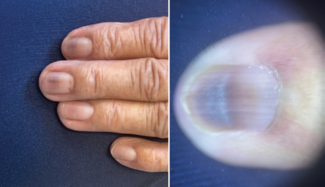 Brown-bluish, pigmented, horizontal nail bands