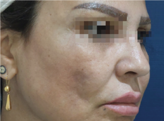 Facial dimpling, skin induration, and soft tissue reaction