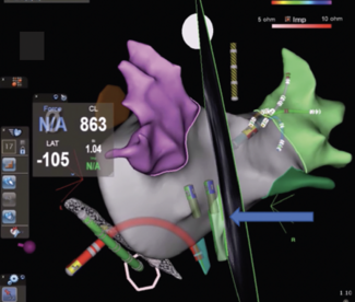 Workflow for Efficiency and Same-Day Discharge: Experience at Ascension  St Vincent’s Medical Center