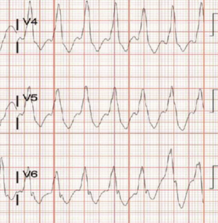 Transition From Transvenous to  Subcutaneous to Extravascular Implantable Cardioverter-Defibrillator: The Right Device for the Right Patient 