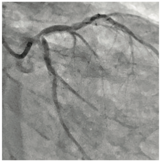 Secemsky Complex Lesions Figure 1