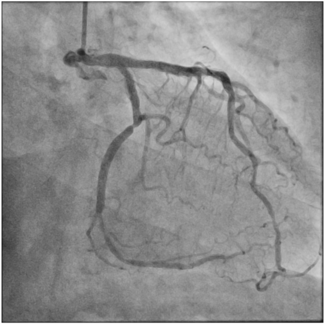 Figure 1, Coronary stent dislodgement