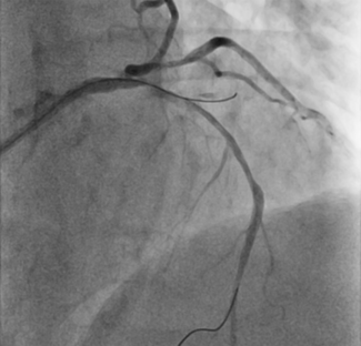 Figure. Subintimal position of initial guidewire