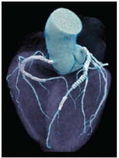 Cinematic-rendered cardiac image visualizing multiple stents.
