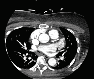 The Key Reason Why Pulsed Field Ablation Will be Embraced: Fear of an Atrio-Esophageal Fistula After Thermal Ablation
