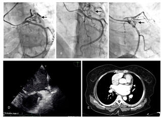 Figure. Coronary angiogram 