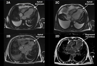 Figure 2. (A) Left ventrıcle apex aneurysm. 
