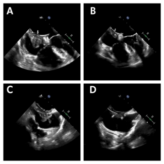 Figure. Transesophageal echocardiogram