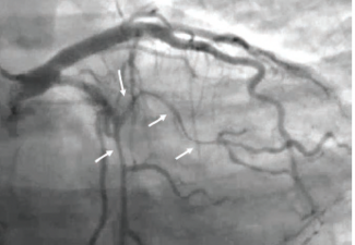 Patient #2. Cine angiogram frame showing diffusely dissected obtuse marginal 1 (arrows).