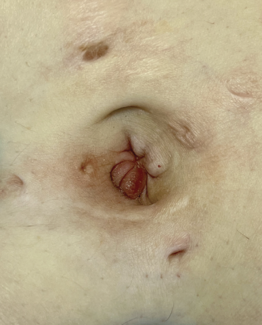 Pink-brown nodule in the umbilicus