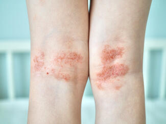 Atopic Dermatitis + Eczema + Itch + Rash + Kids + Legs + Elbow + Knee