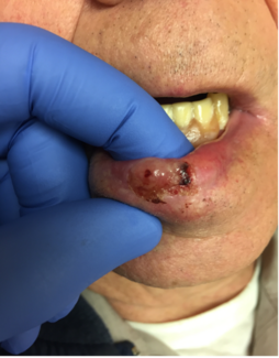 Nodular, Ulcerated Lesion on the Lower Mucosal Lip