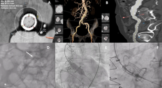 Figure.  Comprehensive imaging in valve-in-valve intervention. 