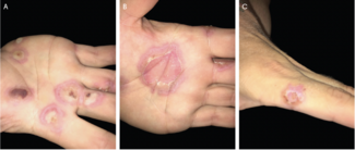 Clinical photographs of multiple polymorphous and target-like erythematous patches and plaques on the palms (A and B) and left second finger (C).