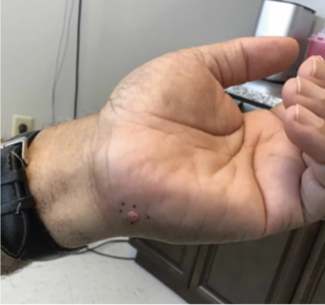 What Is This Pink Lesion on the Palm?