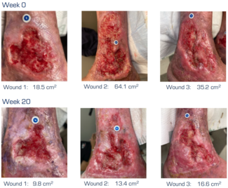 Alsonso-venous-leg-ulcer