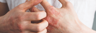 eczema