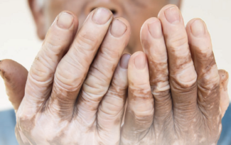 vitiligo