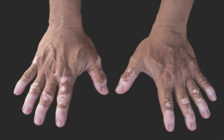 vitiligo