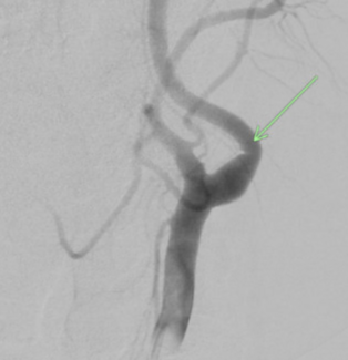 Figure 1. Digital subtraction angiographic image, which shows a small, curvilinear filling defect in the proximal left internal carotid artery reflecting a carotid web. 