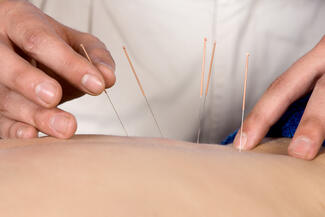 acupuncture 