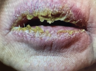 Blisters with large amounts of exudate on the patient’s upper and lower lips