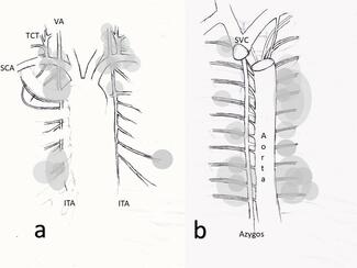 Figure. Mapping Hemorrhage Sites in Spontaneous Hemothorax: Insights From the Literature Review