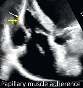 Epstein Hahn - CLD Nov 2024 Papillary Muscle