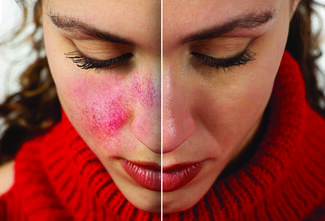 rosacea