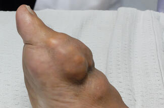 gout nodule on a foot.