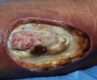 self-inflicted lesion